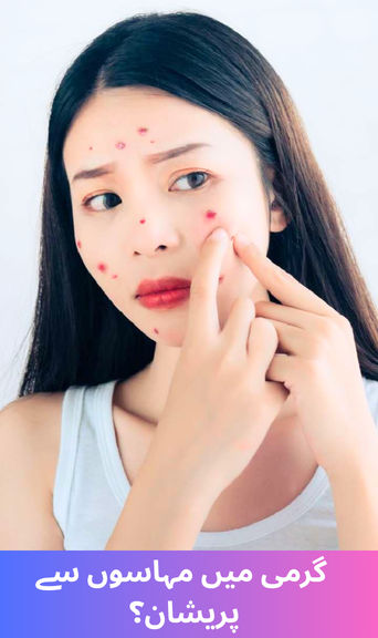 Troubled by Acne in the Summer? These Home Remedies Will Offer Relief